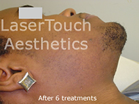 male facial ingrown hair removal - after 6 treatments Morristown